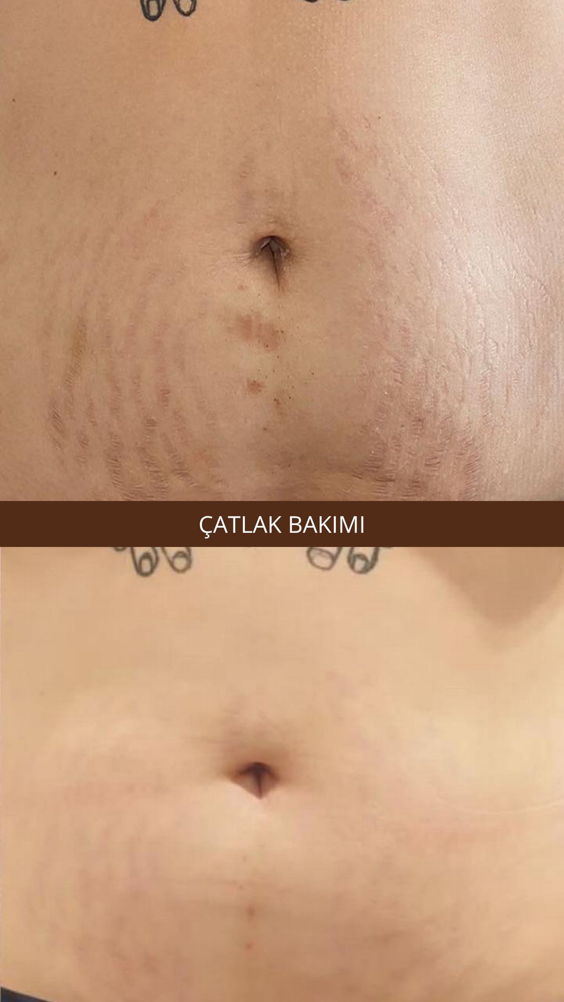 Yüz Lifting